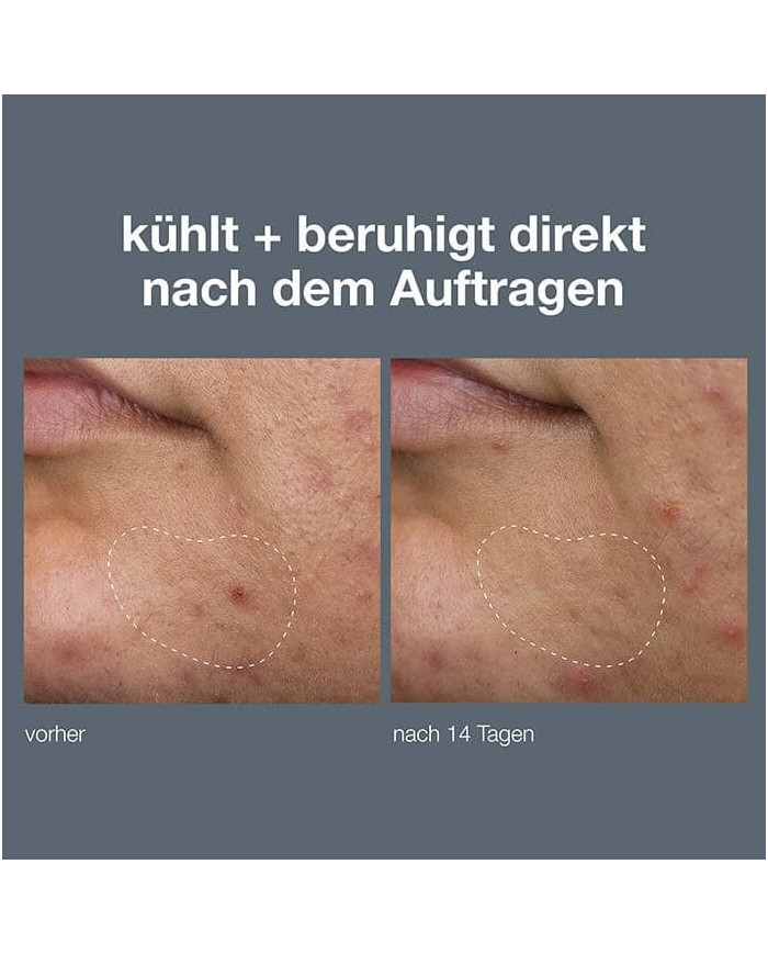 Dermalogica / Deep Breakout Liquid Patch