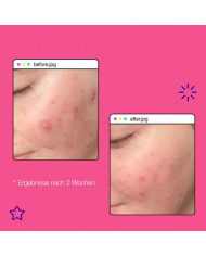 Dermalogica / Breakout Clearing Liquid Peel