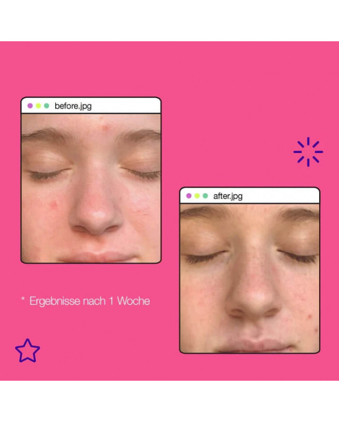 Dermalogica / Breakout Clearing Liquid Peel