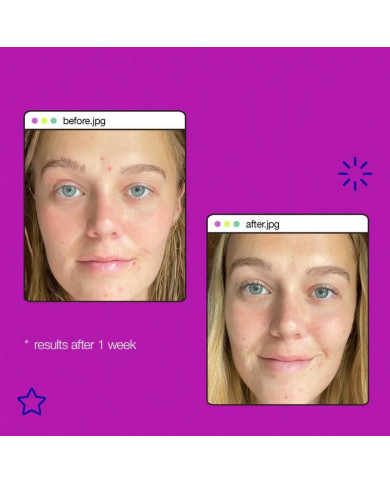 Dermalogica / Post-Breakout Fix