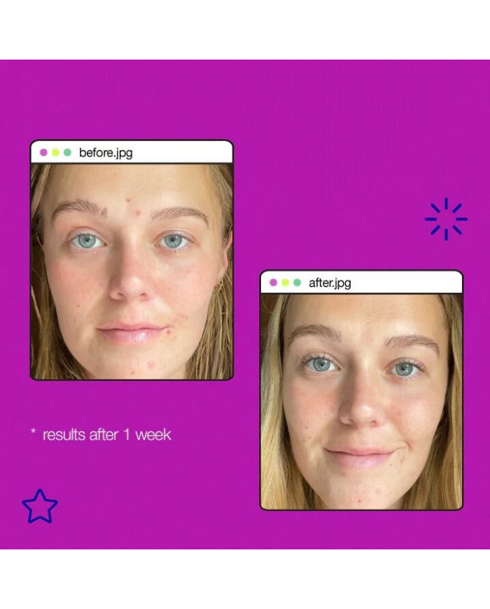 Dermalogica / Post-Breakout Fix