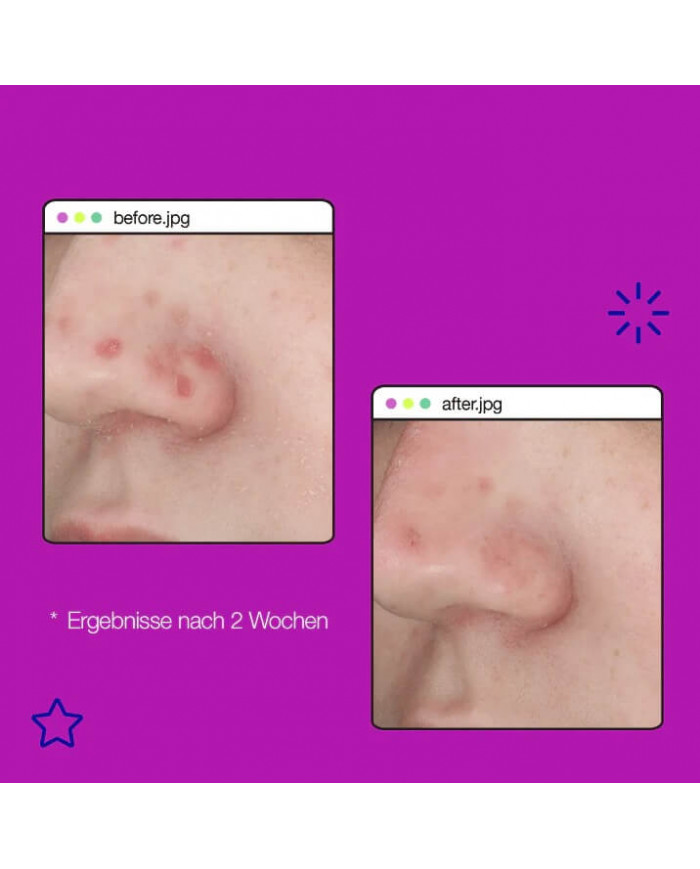 Dermalogica / Post-Breakout Fix